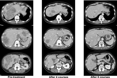 Case Report: Longitudinal monitoring of clonal evolution by circulating tumor DNA for resistance to anti-EGFR antibody in a case of metastatic colorectal cancer